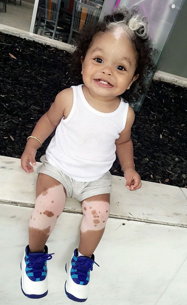 Cette petite fille est née avec la même mèche de cheveux blancs que sa maman | So Busy Girls