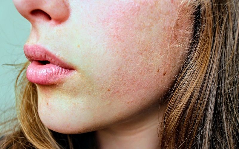 Voici ce que la zone du visage où vous avez des boutons révèle sur vous | So Busy Girls