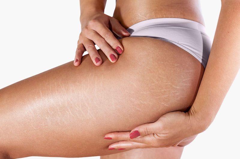7 choses que vous ignoriez sur les vergetures | So Busy Girls