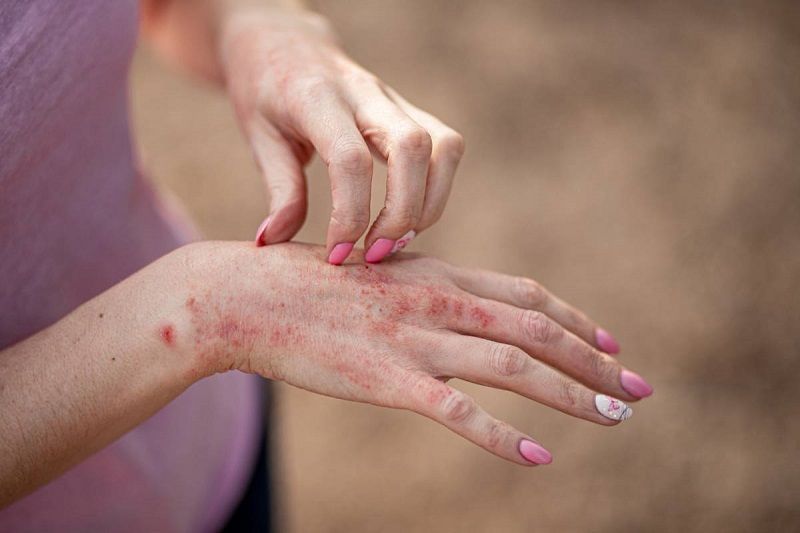 Les facteurs de développement du psoriasis | So Busy Girls