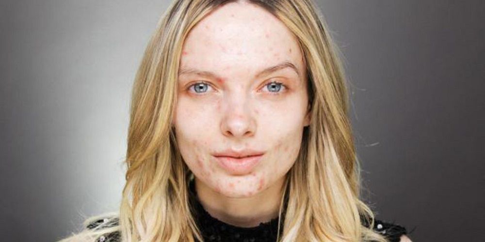 cicatrices-d-acne-comment-les-faire-disparaitre