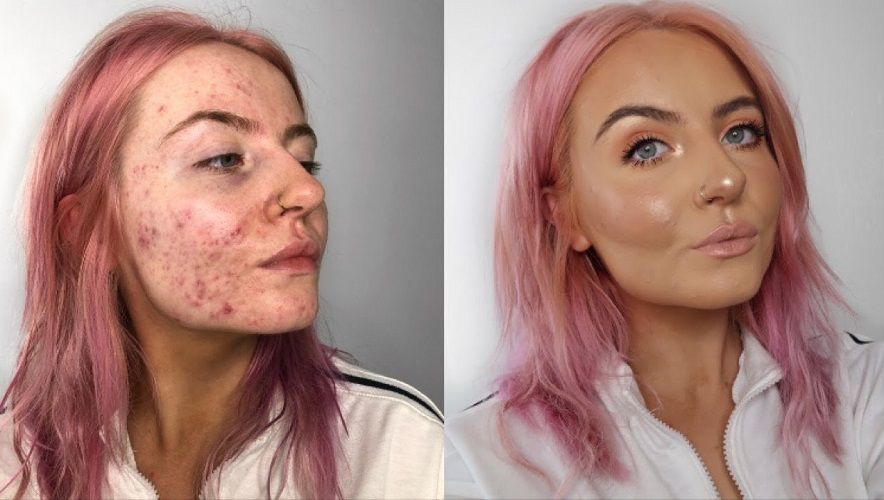 Le fond de teint génial qui permet à cette blogueuse beauté de camoufler ses boutons d'acné à la perfection | So Busy Girls