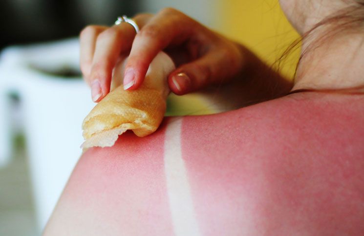 Apaiser un coup de soleil | So Busy Girls