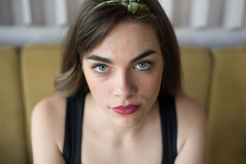 Tout ce que vous devez savoir pour faire disparaître les cicatrices d'acné | So Busy Girls