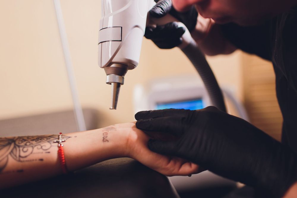 Détatouage laser à Toulouse : comprendre la technique et les bénéfices | So Busy Girls