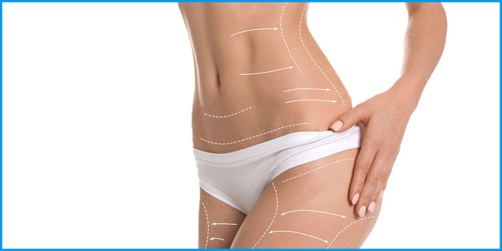liposuccion-femme-ventre