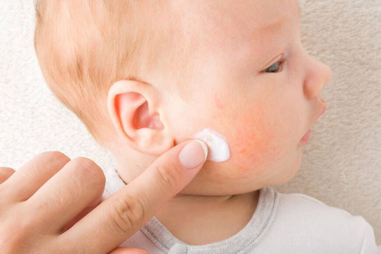 Eczéma chez bébé : comprendre les symptômes et le soulager | So Busy Girls