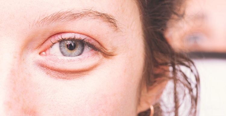 Comment faire partir les poches sous les yeux ?